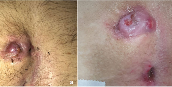 Surgery costs for pilonidal cyst laser in Tehran Surgery costs for pilonidal cyst laser in Tehran