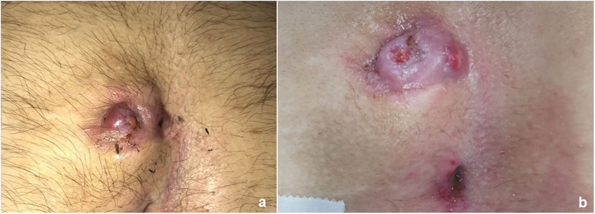 Surgery costs for pilonidal cyst laser in Tehran